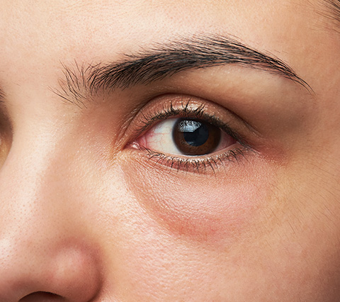Logra verte más joven con nuestro tratamiento de ojeras en Bogotá Ejemplo de un tratamiento de ojeras en Bogotá
